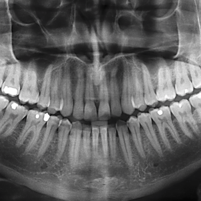 Dental X-ray showing patient’s teeth and jaw structure in Grayson